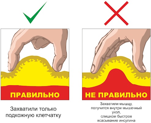 Подкожная инъекция в плечо, живот, бедро. Техника выполнения, введения