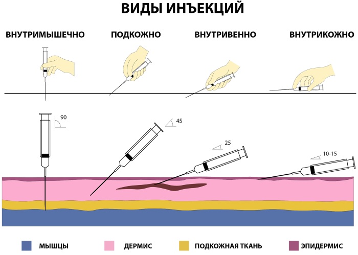 Подкожная инъекция в плечо, живот, бедро. Техника выполнения, введения