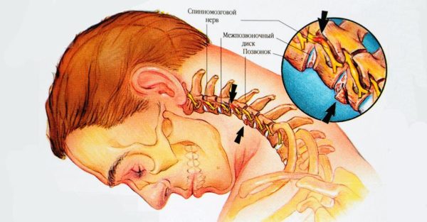 Остеохондроз в шейном отделе приводит к серьезным последствиям, среди которых защемление спинномозговых нервов и разрушение тел позвонков