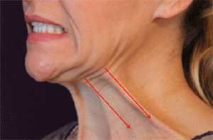 Platysma Tone Double Chin Exercises